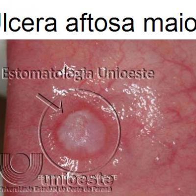01 Ulcera Aftosa Maior