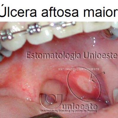 02 Ulcera Aftosa Maior