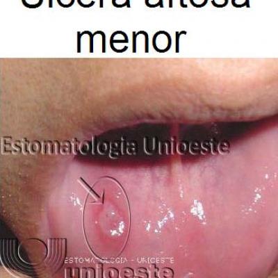 03 Ulcera Aftosa Menor