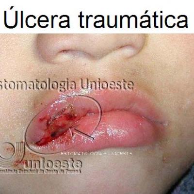 04 Ulcera Traumatica
