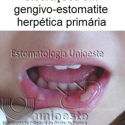 05 Ulceracoes Em Gengivo Estomatite Herpetica Primaria
