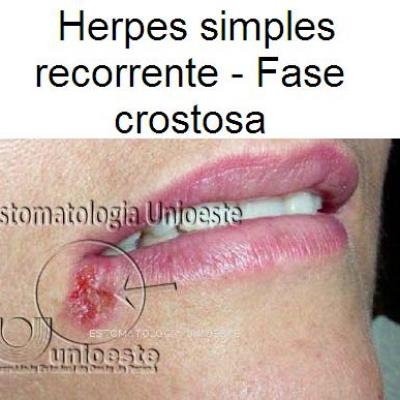 06 Herpes Simples Recorrente Fase Crostosa
