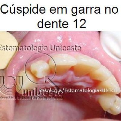 03 Cuspide Em Garra No Dente 12