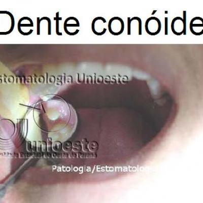 05 Dente Conoide