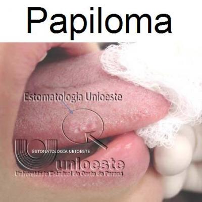 01 Papiloma