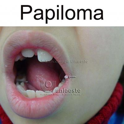 03 Papiloma