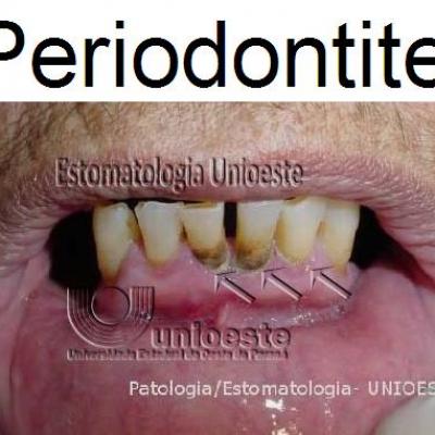 01 Periodontite