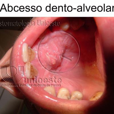 02 Abcesso Dento Alveolar