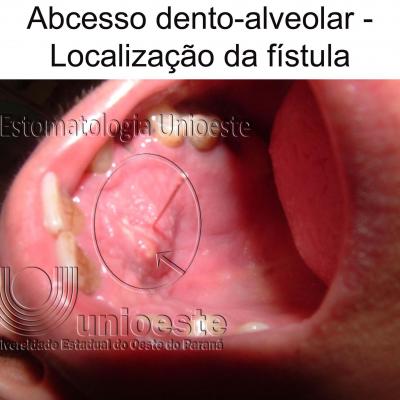 03 Abcesso Dento Alveolar Localizacao Da Fistula