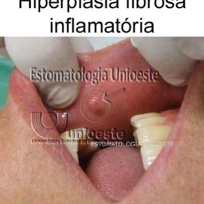 01 Hiperplasia Fibrosa Inflamatoria Focal