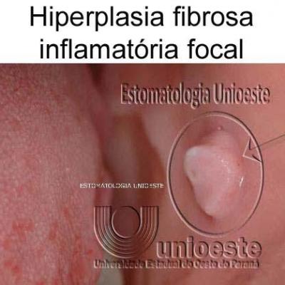 02 Hiperplasia Fibrosa Inflamatoria Focal