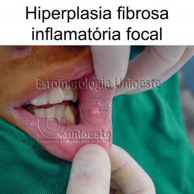 03 Hiperplasia Fibrosa Inflamatoria Focal