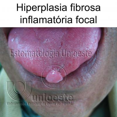 04 Hiperplasia Fibrosa Inflamatoria Focal