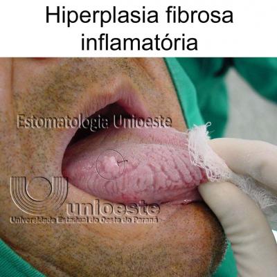 05 Hiperplasia Fibrosa Inflamatoria Focal