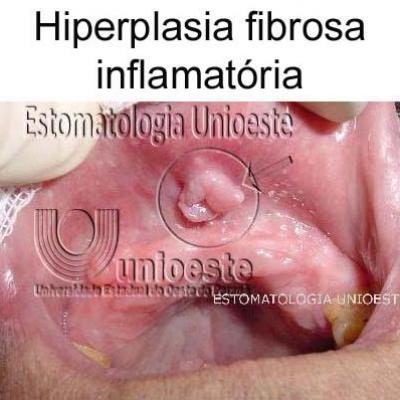 06 Hiperplasia Fibrosa Inflamatoria
