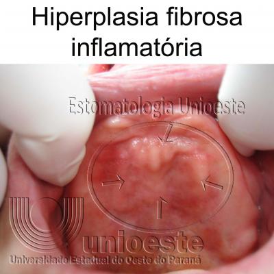 07 Hiperplasia Fibrosa Inflamatoria