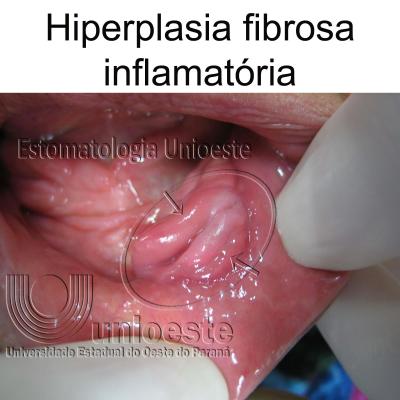 08 Hiperplasia Fibrosa Inflamatoria