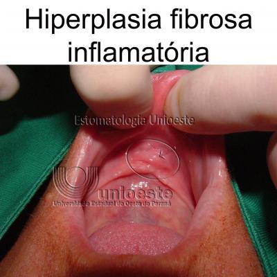 09 Hiperplasia Fibrosa Inflamatoria