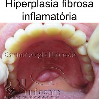 10 Hiperplasia Fibrosa Inflamatoria