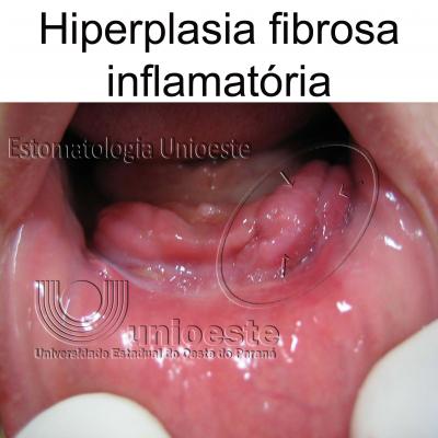 11 Hiperplasia Fibrosa Inflamatoria