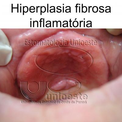 13 Hiperplasia Fibrosa Inflamatoria
