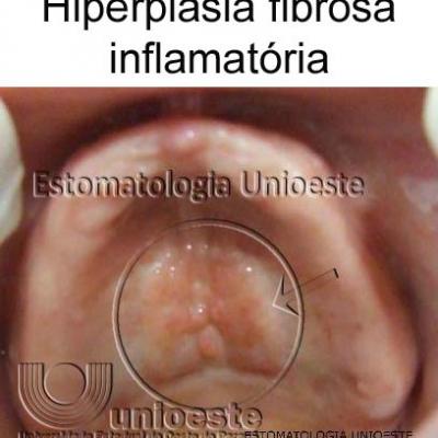 14 Hiperplasia Fibrosa Inflamatoria Causada Por Camera De Succao