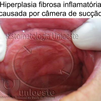 15 Hiperplasia Fibrosa Inflamatoria Causada Por Camera De Succao