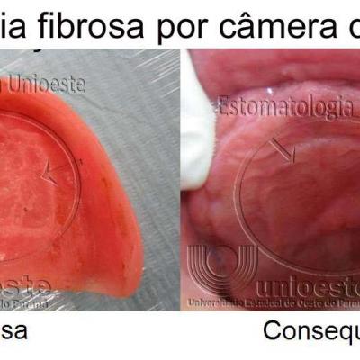 17 Hiperplasia Fibrosa Inflamatoria Por Camera De Succao