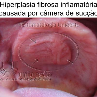 18 Hiperplasia Fibrosa Inflamatoria Causada Por Camera De Succao