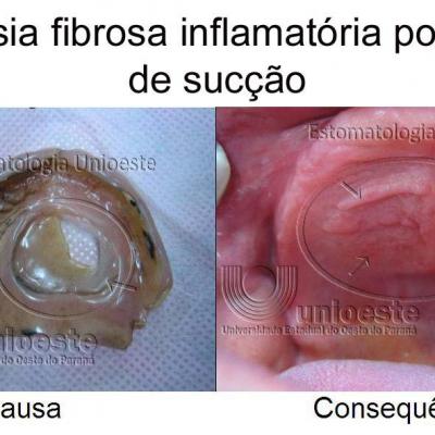 20 Hiperplasia Fibrosa Inflamatoria Causada Por Camera De Succao