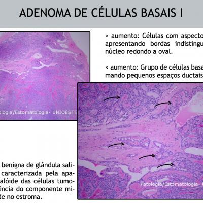Adenoma De Clulas Basais 1 Cpia Thumbnail