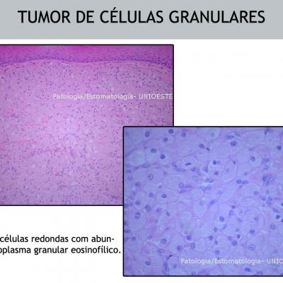 Tumor De Clulas Granulares Pia