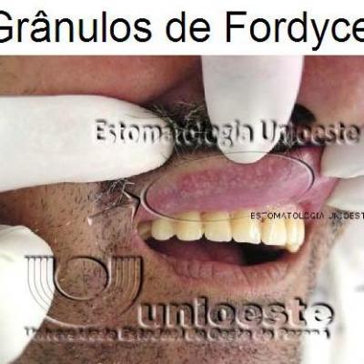 01 Granulos De Fordyce