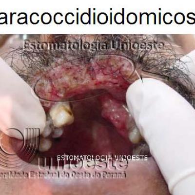 01 Paracoccidioidomicose