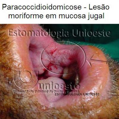 02 Paracoccidioidomicose Lesao Moriforme Em Mucosa Jugal